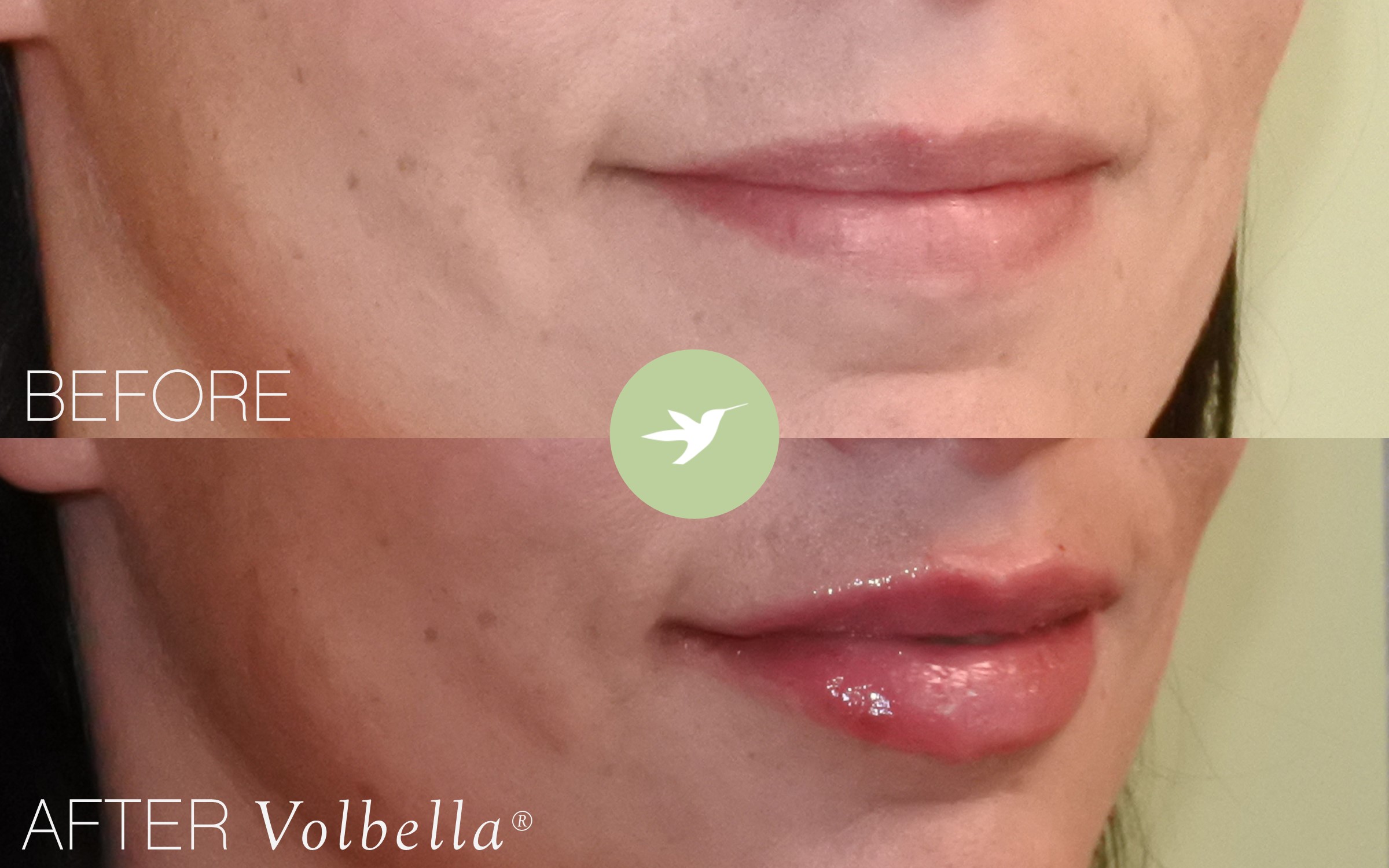 Juvederm Volbella for Lips Pump Up the Volume! Skin by Lovely