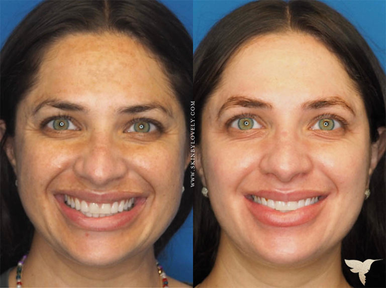 Cosmelan Depigmentation Peel Before and After