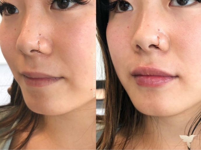 Before and after of Juvederm Ultra XC in lips Los Angeles Portland