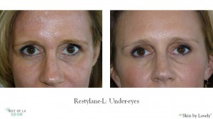 restylane under-eyes before and afters