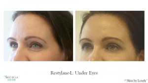 restylane under-eyes before and afters