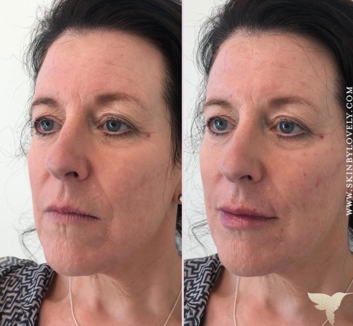 Revance RHA dermal fillres in lips, chin and cheeks in Lake Oswego