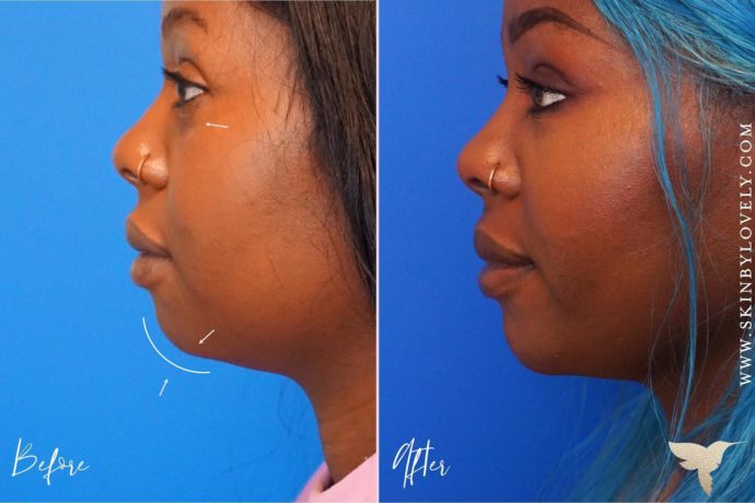 Juvederm Before and After Pictures