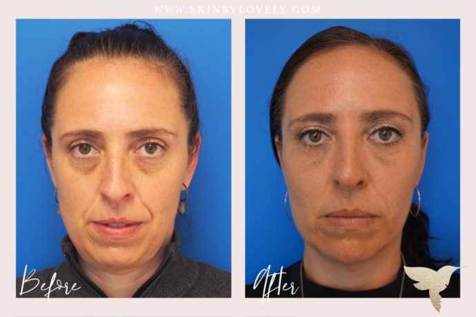 Restylane and Juvederm Ultra Plus for for nasolabial folds, marionette lines, lips and under eyes