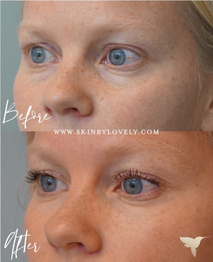 Dermal filler for under eye circle rejuvenation in Los Angeles and Portland