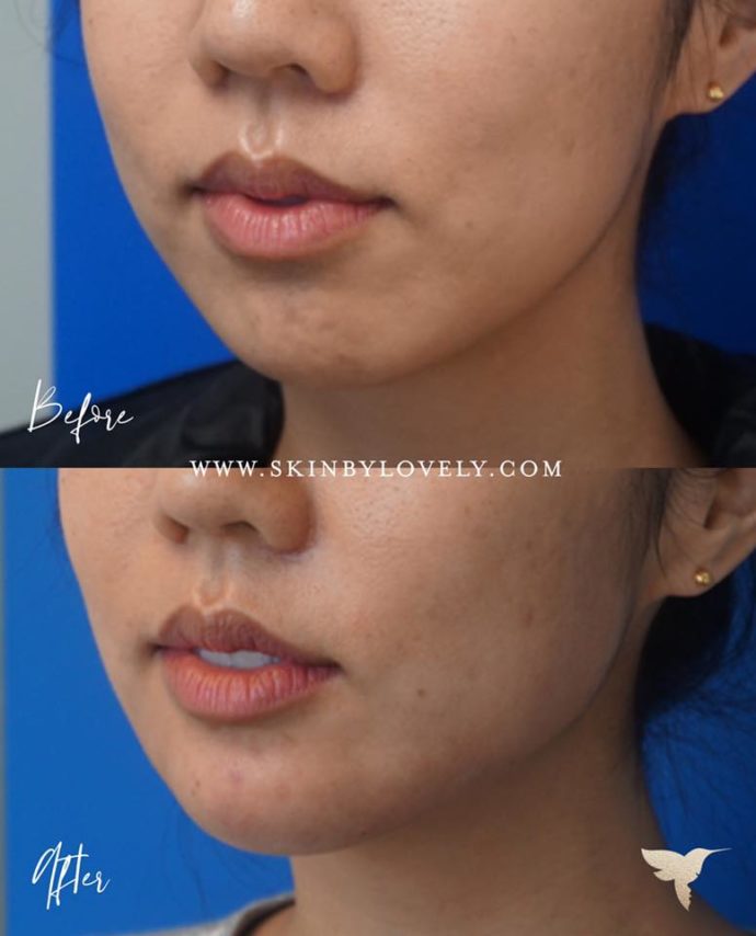 Restylane Lyft and Juvederm Voluma dermal filler for chin enhancement in Santa Monica and Portland