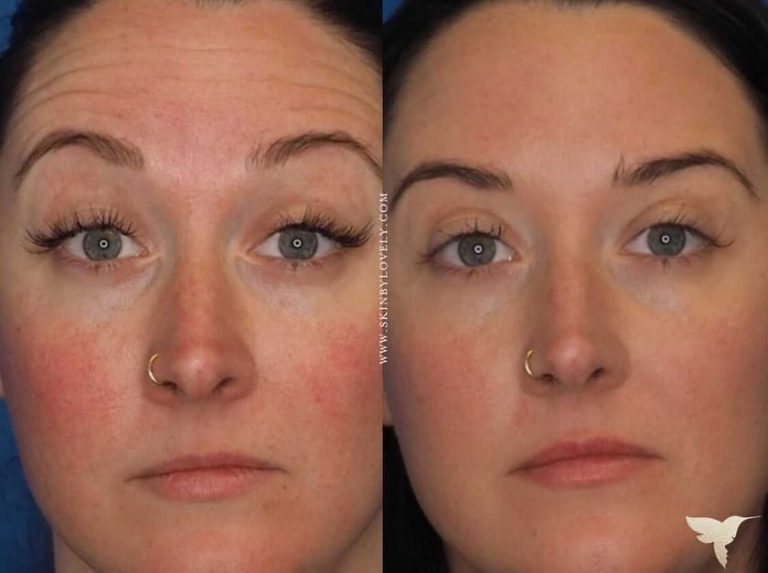 Before and after Botox wrinkle relaxer Treatment at Skin by Lovely Lake Oswego