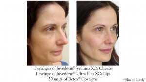 juvederm voluma xc before and after