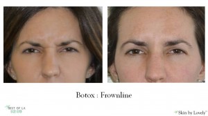 botox before and after