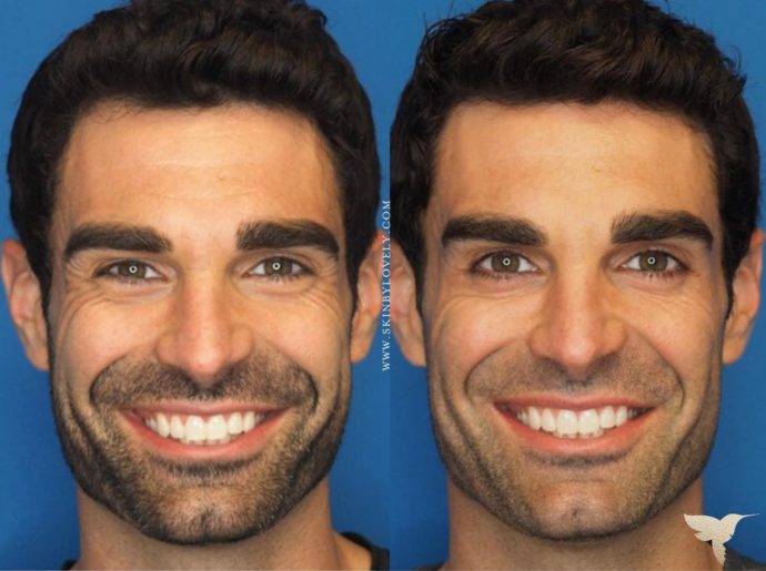 Men's Dysport Treatment Before and After at Skin by Lovely Los Angeles 