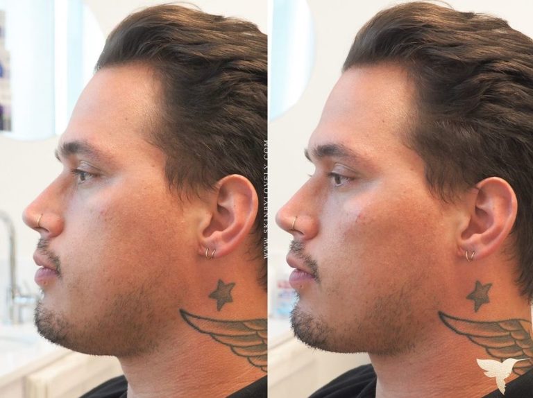 Restylane contour cheeks before and after in Lake Oswego, Oregon