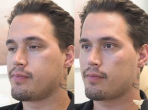 Restylane Contour before and after men at Skin by Lovely Portland, Oregon