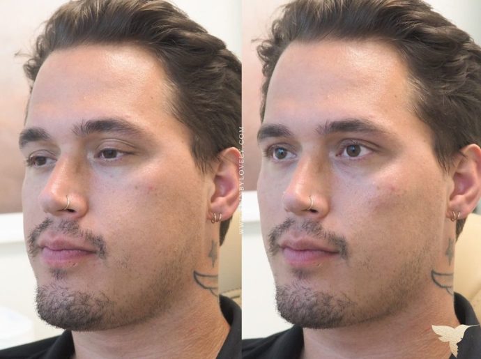 Restylane contour cheeks before and after in Lake Oswego, Oregon