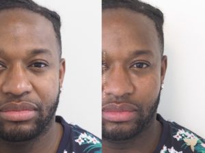 Male's before and after under-eye rejuvenation at Skin by Lovely Santa Monica