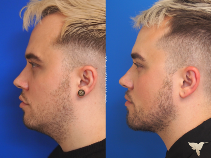Male Kybella before and after results