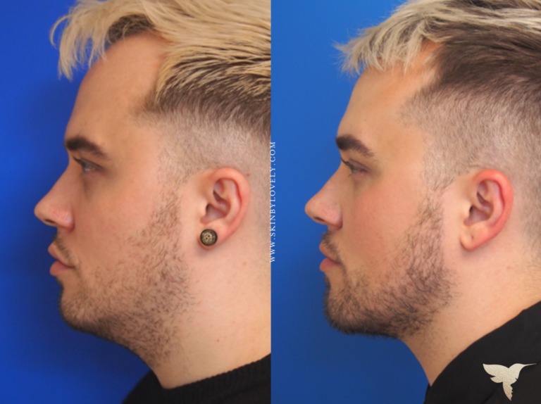 Skin by Lovely Before and After Jawline and Kybella in Portland