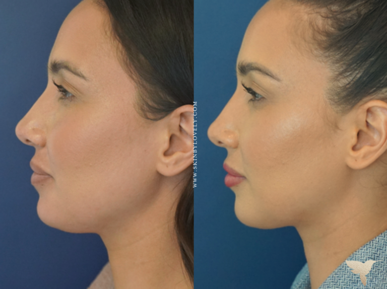 Skin by Lovely Before and After Jawline In Santa Monica