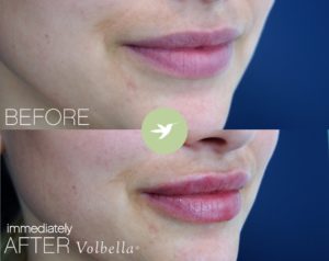 juvederm volbella for lips santa monica