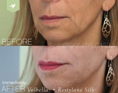 Restylane Silk and Juvederm Volbella for Lips