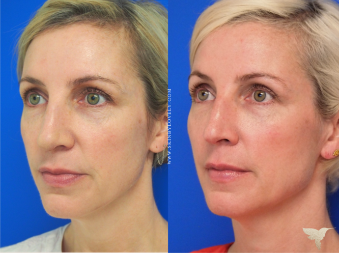 Skin by Lovely Sculptra Aesthetic Before and After Results