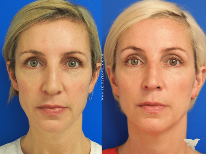 Skin by Lovely Sculptra Aesthetic Before and After Results in Portland