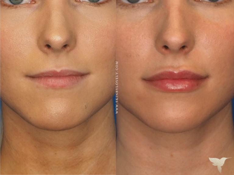 Lip filler before and after