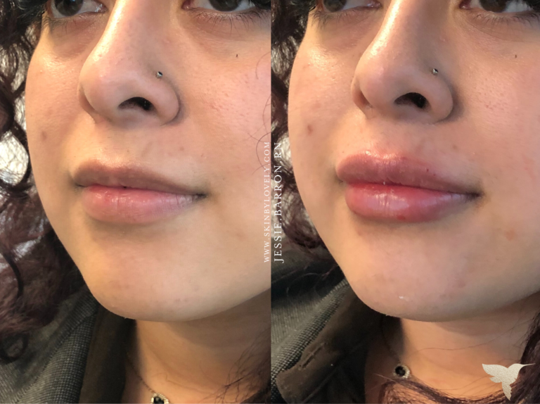 Lip filler before and after at Skin by Lovely in Portland