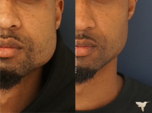 Masseter Reducion for Bruxism with Men at Skin by Lovely in Santa Monica