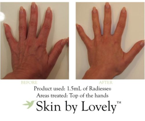 before and after radiesse hands