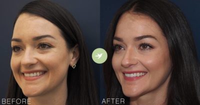 restylane defyne before and after