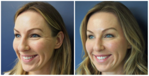 Before and After of Dysport for Crow's Feet at Skin by Lovely Santa Monica