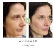 aphrodite lift before and after