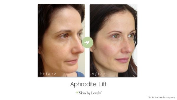 Aphrodite Lift before and after