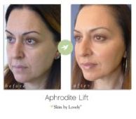 aphrodite lift before and after