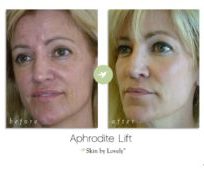 aphrodite lift before and after