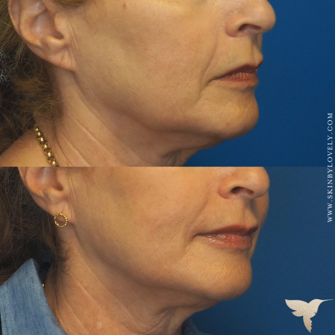 Skin by Lovely Before and After Vertical Lip Lines and Nasolabial Folds