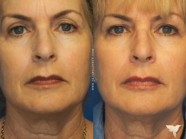 Skin by Lovely Before and After Marionette Lines and Nasolabial Folds
