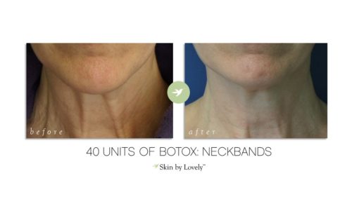 Botox neck lift