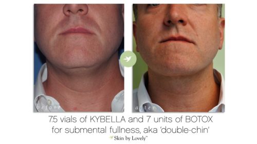 kybella double chin reduction
