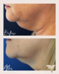 turkey neck double chin kybella