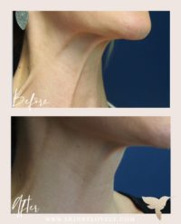 botox neck lift turkey neck treatment