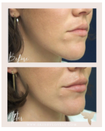 lip filler before and after