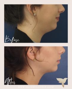 Kybella results