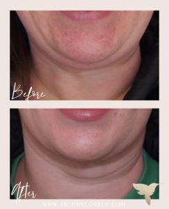 Kybella results