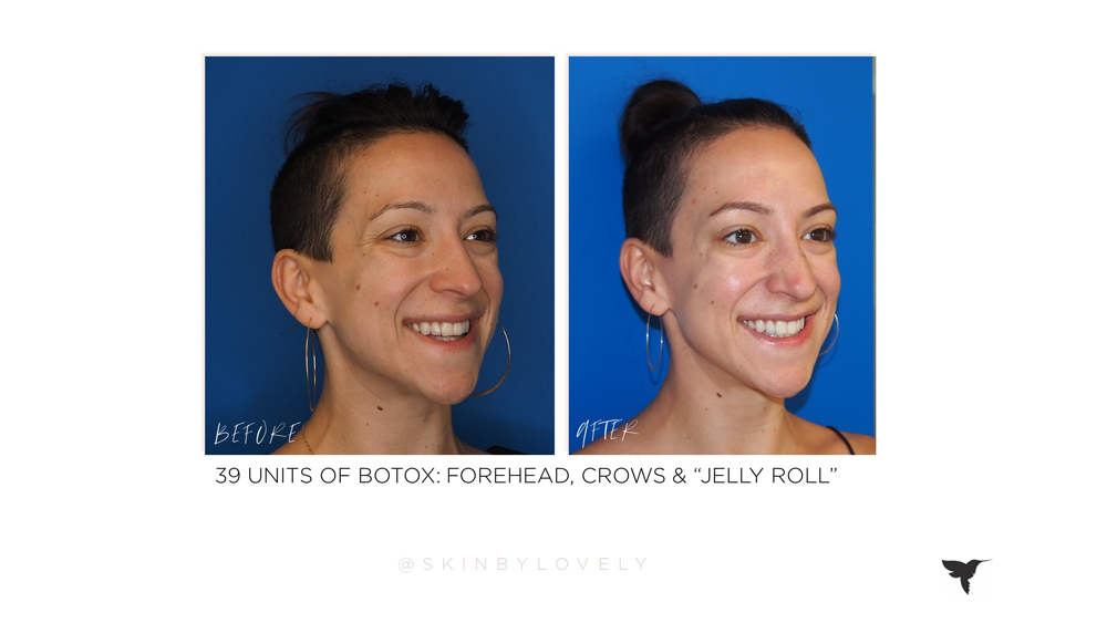 botox before and afters in jelly roll portland oregon