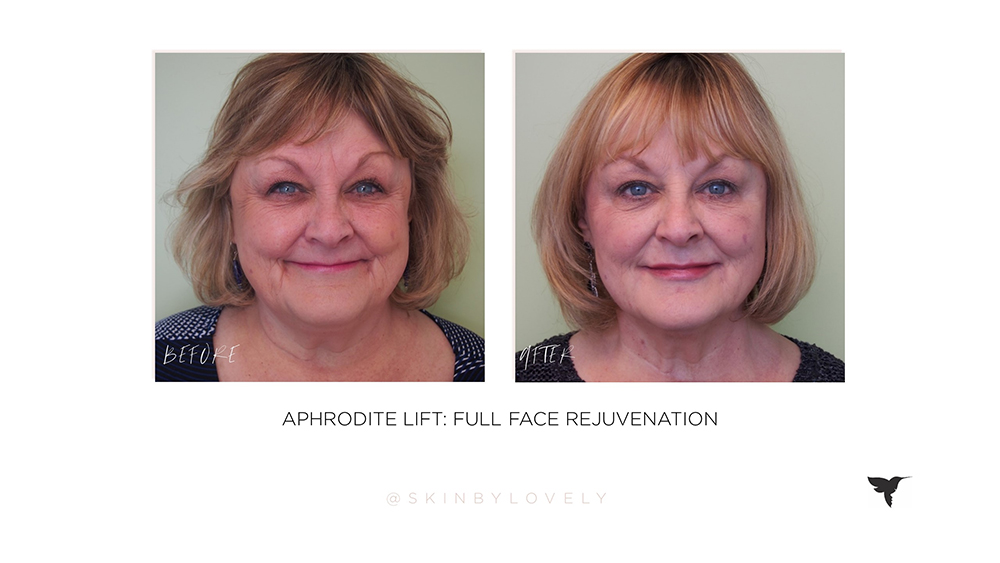 full face dermal filler and botox beforea and after