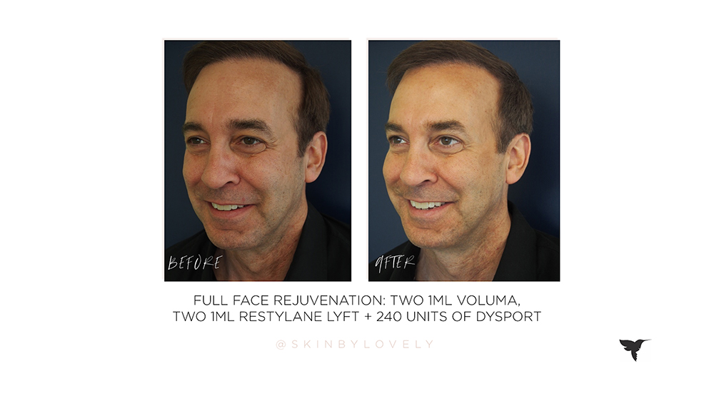 male cheek dermal filler before and after