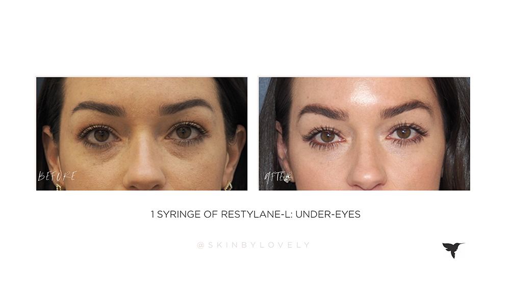 under-eye dermal filler before and after in santa monica