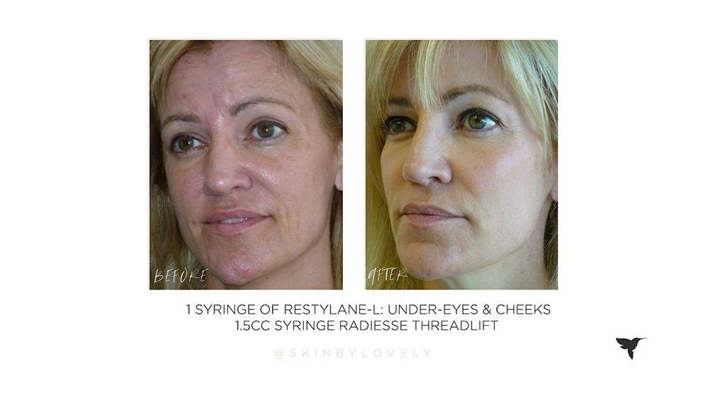 Radiesse in cheeks before and after