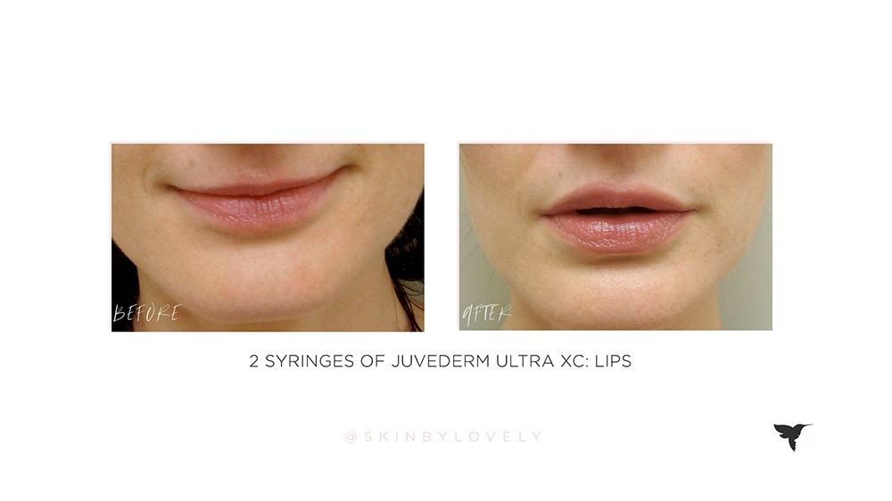 juvederm ultra xc in lips before and after